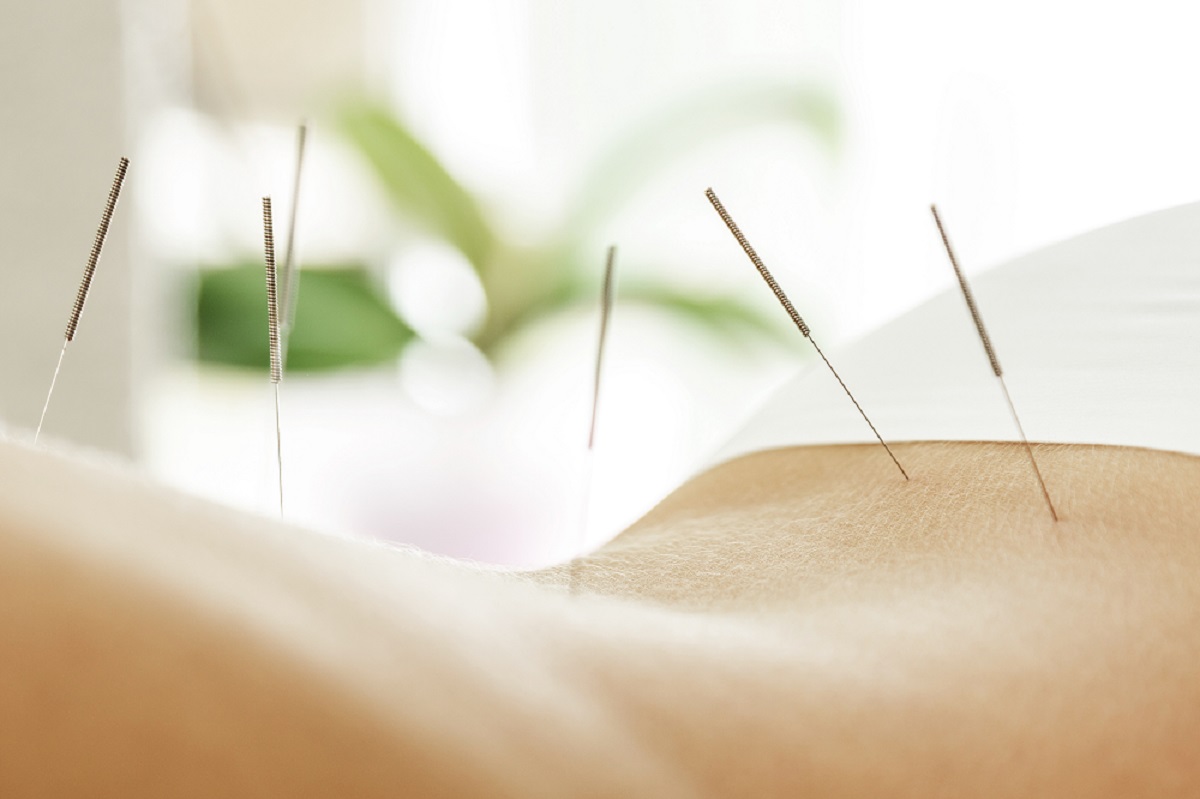 Akupunktur abnehmen